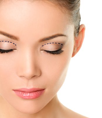 Blepharoplasty (removal of drooping eyelids and puffiness around the eyes)