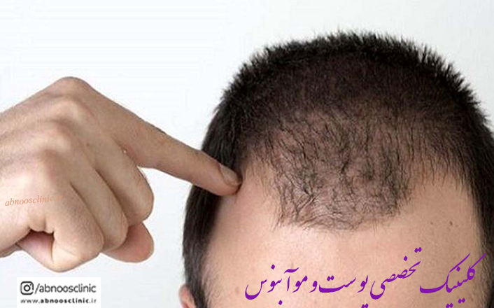 ریزش مو دلایل و روش های درمان آنها