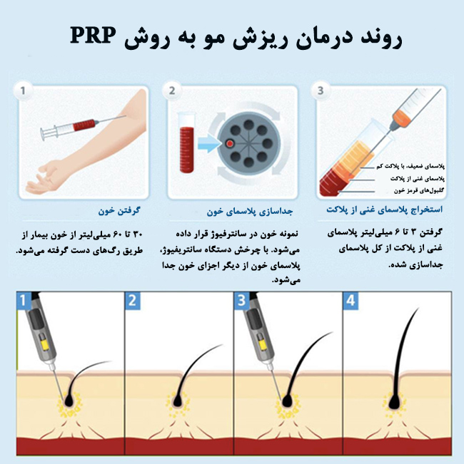 مراحل PRP برای ترمیم مو
