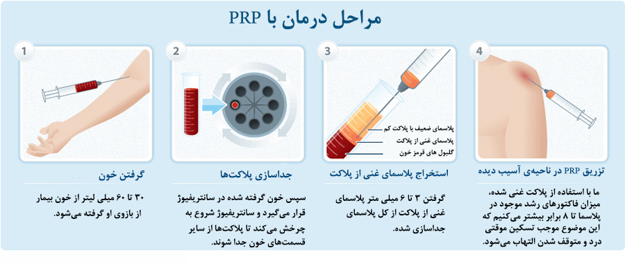 روند PRP درمانی