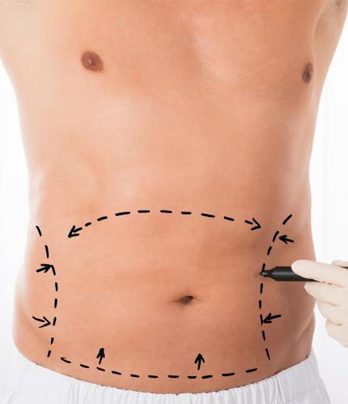 Abdominoplasty counseling (beauty and fitness of body and abdomen)