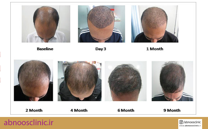 رشد مو ها بعد کاشت مو چگونه است ؟ |کلینیک پوست و مو آبنوس مشهد