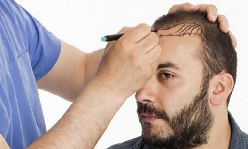 5 عاملی که در "کاشت موی ناموفق" نقش دارند|کلینیک پوست ومو آبنوس